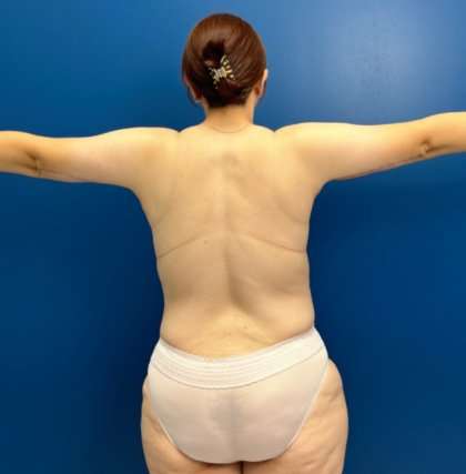 Tummy Tuck Before & After Patient #260