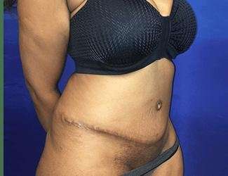 Tummy Tuck Before & After Patient #349