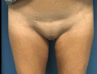 Labiaplasty Before & After Patient #1319