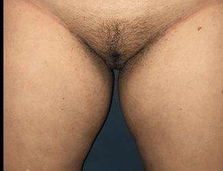 Labiaplasty Before & After Patient #1324
