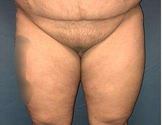 Labiaplasty Before & After Patient #1329