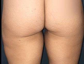 Labiaplasty Before & After Patient #1340