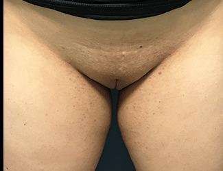 Labiaplasty Before & After Patient #2772
