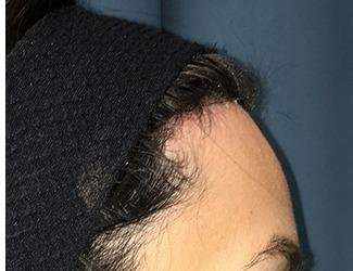 Forehead Reduction Before & After Patient #1364