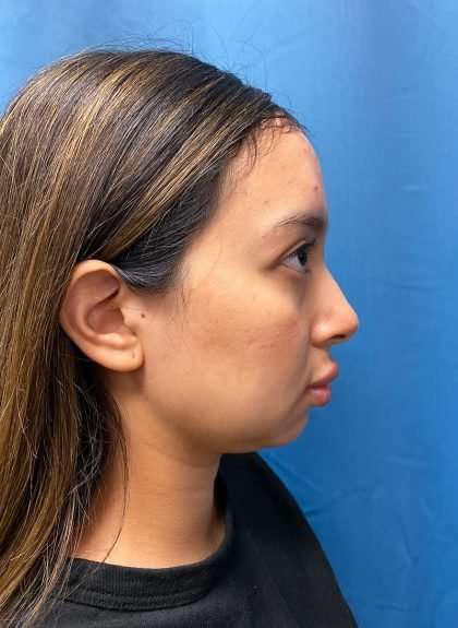 Forehead Reduction Before & After Patient #1371