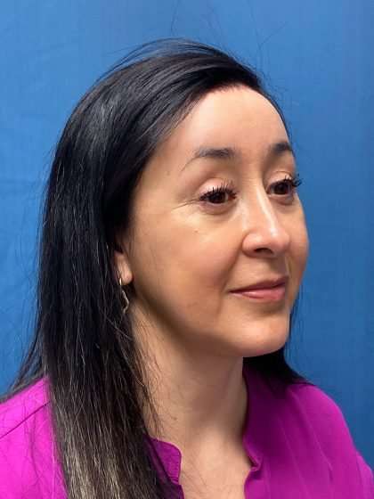 Forehead Reduction Before & After Patient #1376