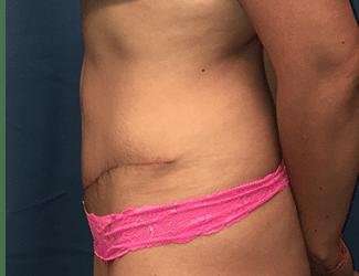Tummy Tuck Before & After Patient #358