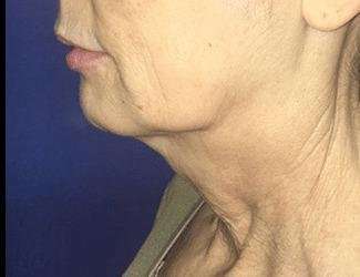 Facial Implants Before & After Patient #1392