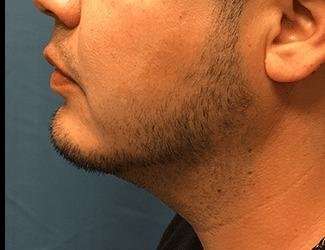 Facial Implants Before & After Patient #1403
