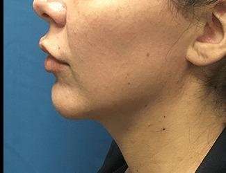 Facial Implants Before & After Patient #1427