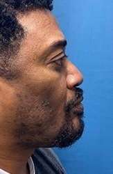 Facial Implants Before & After Patient #1440