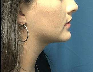 Facial Implants Before & After Patient #1453