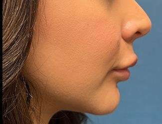 Facial Implants Before & After Patient #1475
