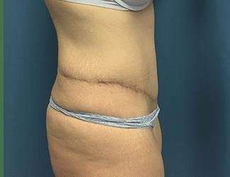 Tummy Tuck Before & After Patient #369