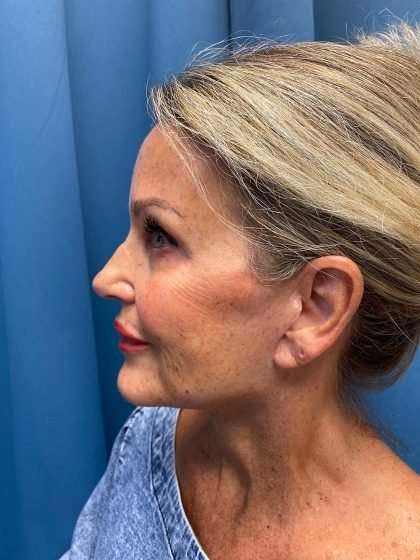 Facelift And Necklift Before & After Patient #1497