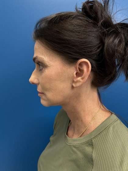 Facelift And Necklift Before & After Patient #1506