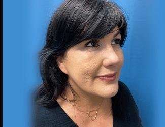 Facelift And Necklift Before & After Patient #1513