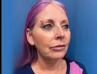 Facelift And Necklift Before & After Patient #1520