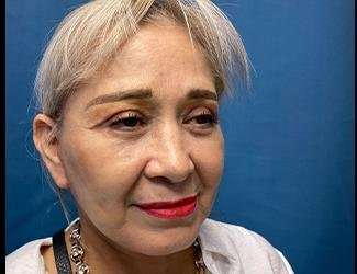 Facelift And Necklift Before & After Patient #1531