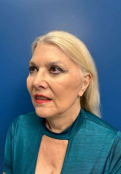 Facelift And Necklift Before & After Patient #1542