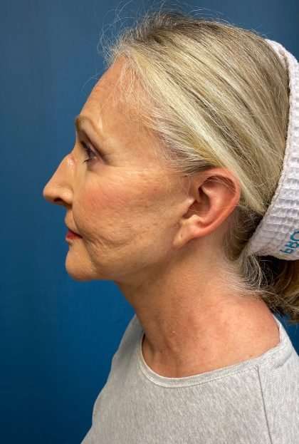 Facelift And Necklift Before & After Patient #1549