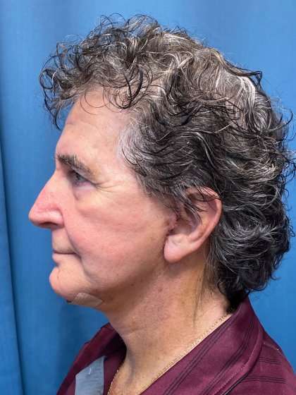 Facelift And Necklift Before & After Patient #1560