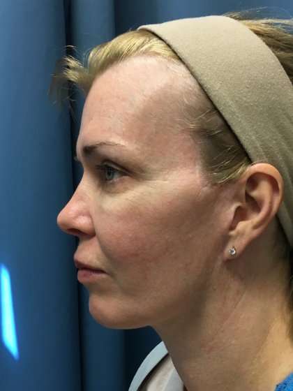 Facelift And Necklift Before & After Patient #1582