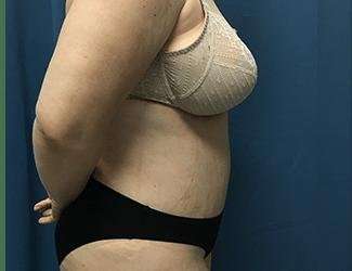 Tummy Tuck Before & After Patient #380