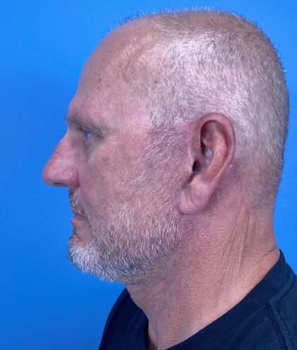 Facelift And Necklift Before & After Patient #1593