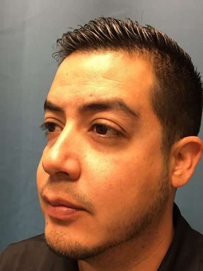 Chin Implant Before & After Patient #1604