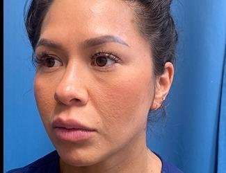Buccal Fat Removal Before & After Patient #1643