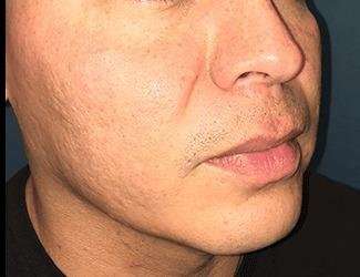 Buccal Fat Removal Before & After Patient #1656