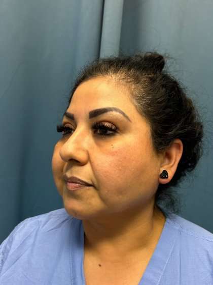 Buccal Fat Removal Before & After Patient #1663