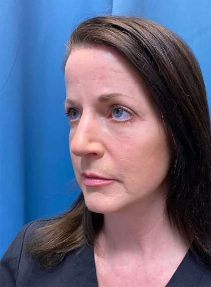 Brow Lift Before & After Patient #1674