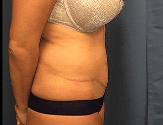 Tummy Tuck Before & After Patient #395