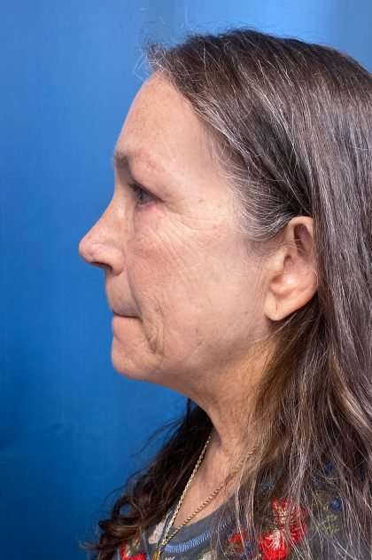 Brow Lift Before & After Patient #1685