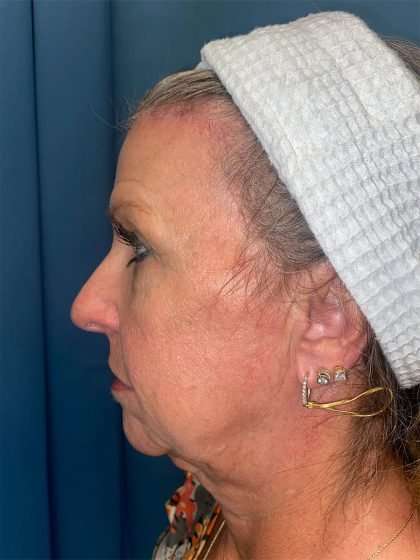 Brow Lift Before & After Patient #1694