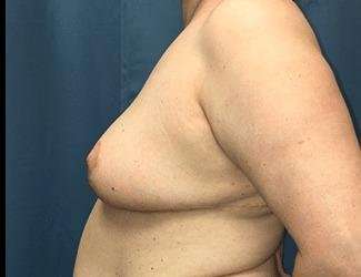 Breast Reduction Before & After Patient #1727
