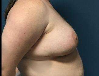 Breast Reduction Before & After Patient #1738