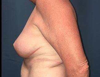 Breast Reduction Before & After Patient #1760