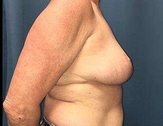 Breast Reduction Before & After Patient #1771