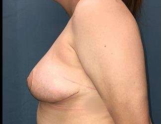 Breast Reduction Before & After Patient #1793