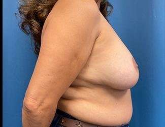 Breast Reduction Before & After Patient #1804