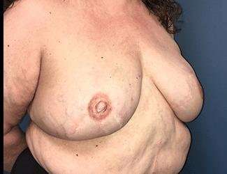 Breast Reduction Before & After Patient #1815