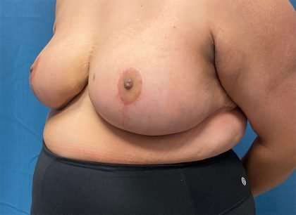 Breast Reduction Before & After Patient #1829