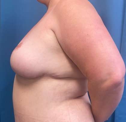 Breast Lift Before & After Patient #1872