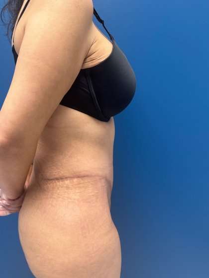 Tummy Tuck Before & After Patient #417