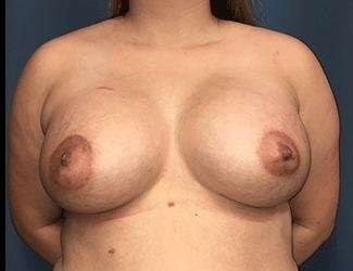Breast Lift Before & After Patient #1903
