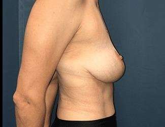 Breast Lift Before & After Patient #1923