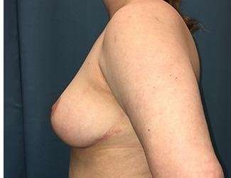 Breast Lift Before & After Patient #1945